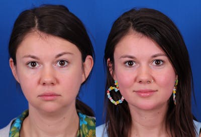 Neck deFINE Before & After Gallery - Patient 341323 - Image 2