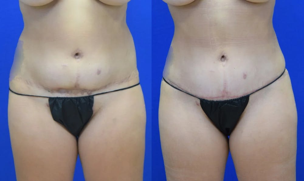 Tummy Tuck Before & After Gallery - Patient 527265 - Image 1