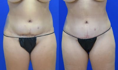 Revision Body Before & After Gallery - Patient 398822 - Image 1