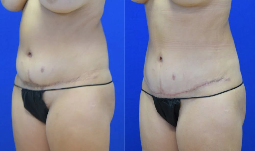 Tummy Tuck Before & After Gallery - Patient 527265 - Image 2