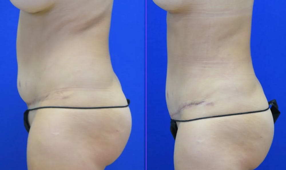 Tummy Tuck Before & After Gallery - Patient 527265 - Image 3