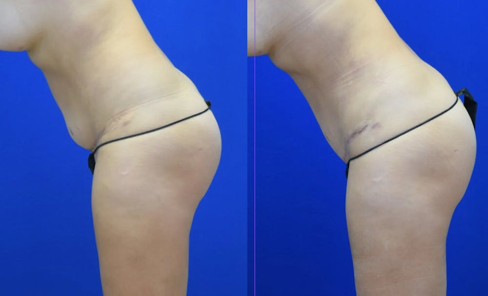 Tummy Tuck Before & After Gallery - Patient 527265 - Image 4
