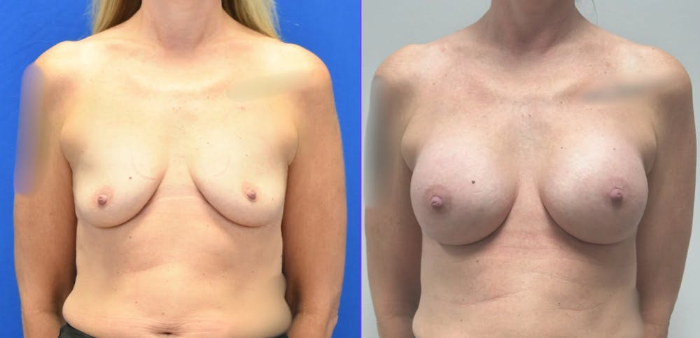 Breast Augmentation Before & After Gallery - Patient 158714 - Image 1