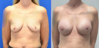 Breast Augmentation Before & After Gallery - Patient 158714 - Image 1
