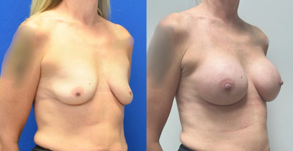 Breast Augmentation Before & After Gallery - Patient 158714 - Image 2