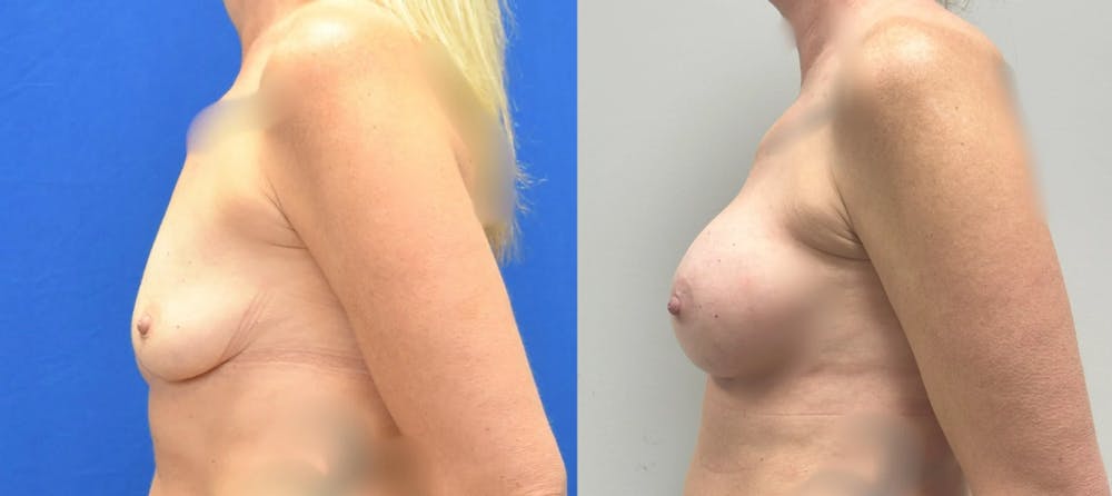 Breast Augmentation Before & After Gallery - Patient 158714 - Image 3