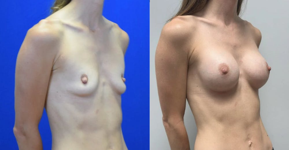 Breast Augmentation Before & After Gallery - Patient 104196 - Image 2
