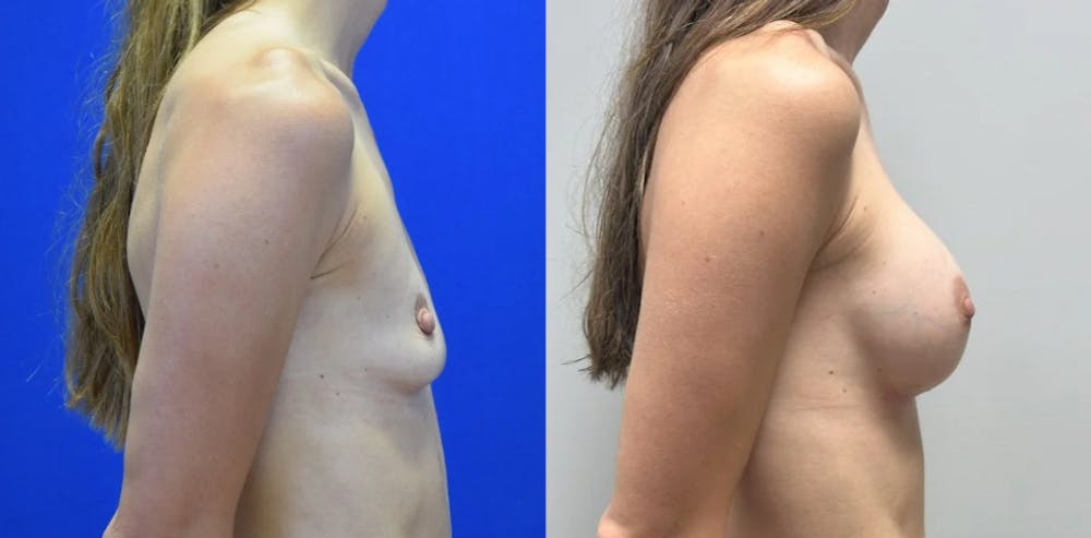 Breast Augmentation Before & After Gallery - Patient 104196 - Image 3