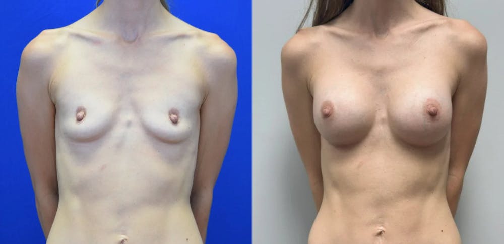 Breast Augmentation Before & After Gallery - Patient 104196 - Image 1