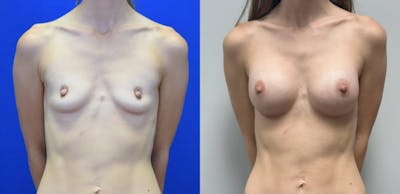 Breast Augmentation Before & After Gallery - Patient 104196 - Image 1