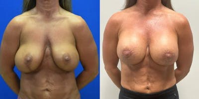 Revision Body Before & After Gallery - Patient 721721 - Image 1