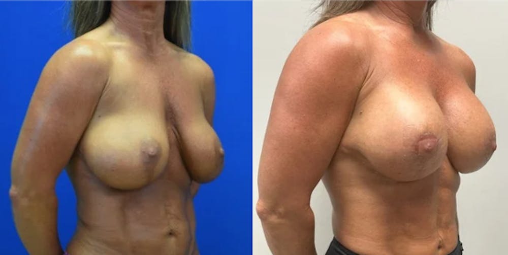 Revision Body Before & After Gallery - Patient 721721 - Image 2