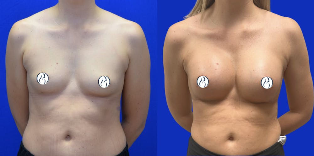 Breast Augmentation Before & After Gallery - Patient 152264 - Image 1