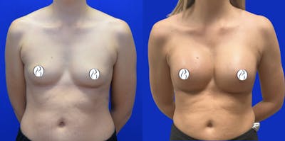 Breast Augmentation Before & After Gallery - Patient 152264 - Image 1