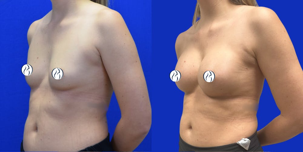 Breast Augmentation Before & After Gallery - Patient 152264 - Image 5