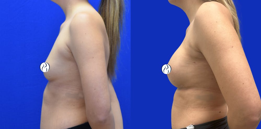 Breast Augmentation Before & After Gallery - Patient 152264 - Image 4