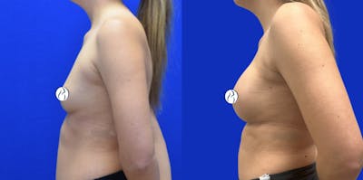 Breast Augmentation Before & After Gallery - Patient 152264 - Image 4