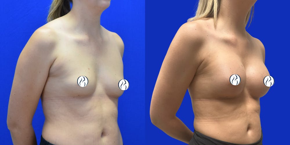 Breast Augmentation Before & After Gallery - Patient 152264 - Image 2
