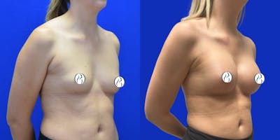 Breast Augmentation Before & After Gallery - Patient 152264 - Image 2