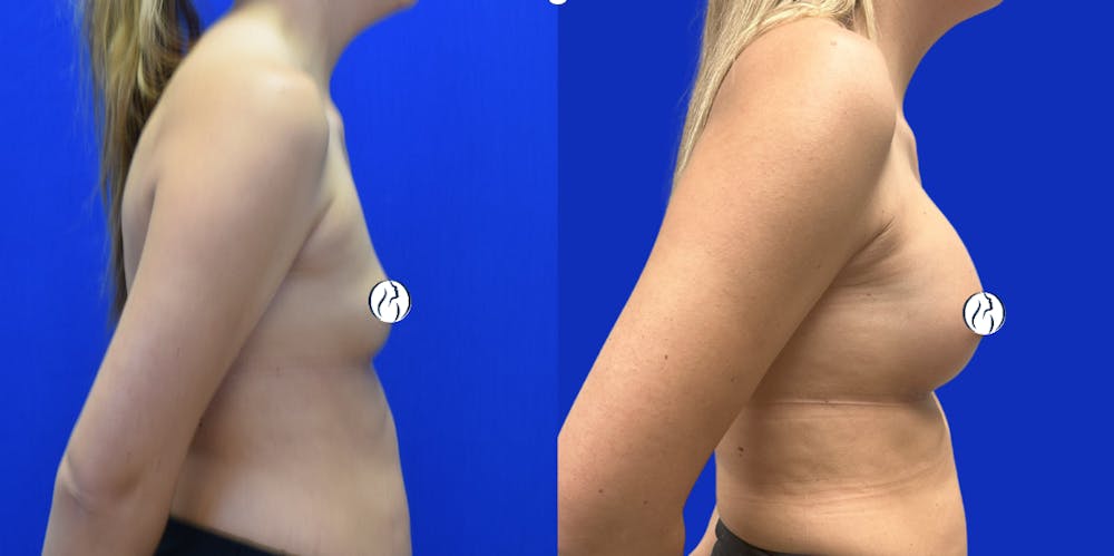 Breast Augmentation Before & After Gallery - Patient 152264 - Image 3