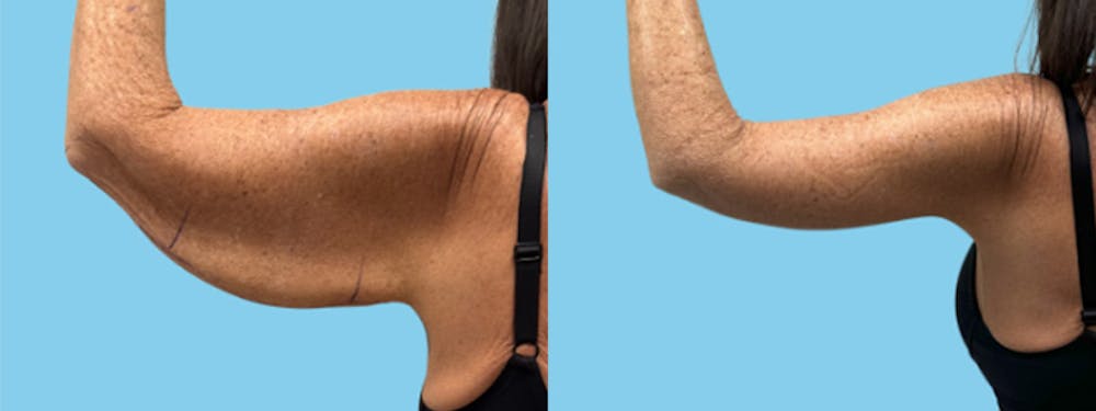 Brachioplasty Before & After Gallery - Patient 315456 - Image 1