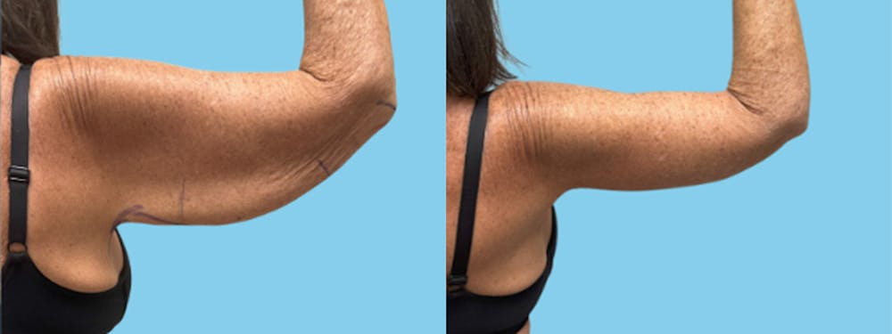 Brachioplasty Before & After Gallery - Patient 315456 - Image 2