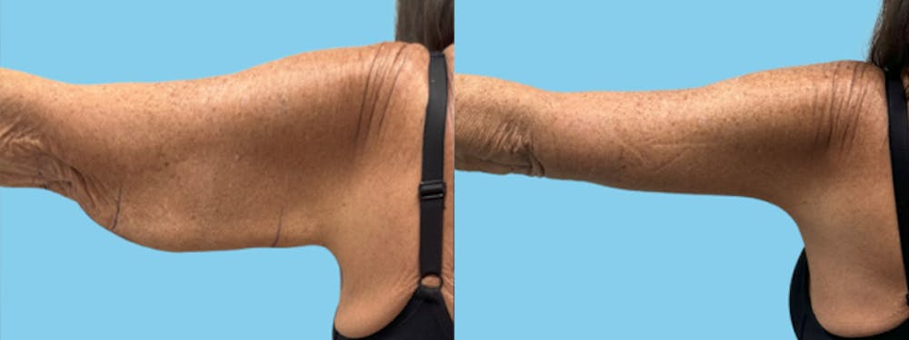 Brachioplasty Before & After Gallery - Patient 315456 - Image 3