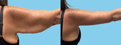 Brachioplasty Before & After Gallery - Patient 315456 - Image 4