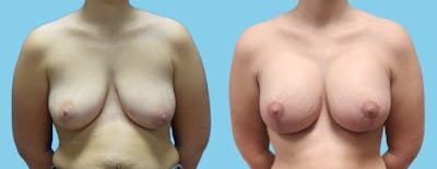 Breast Augmentation Before & After Gallery - Patient 716029 - Image 1