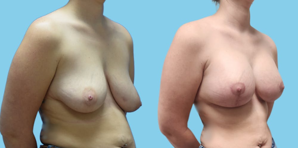 Breast Augmentation Before & After Gallery - Patient 716029 - Image 2