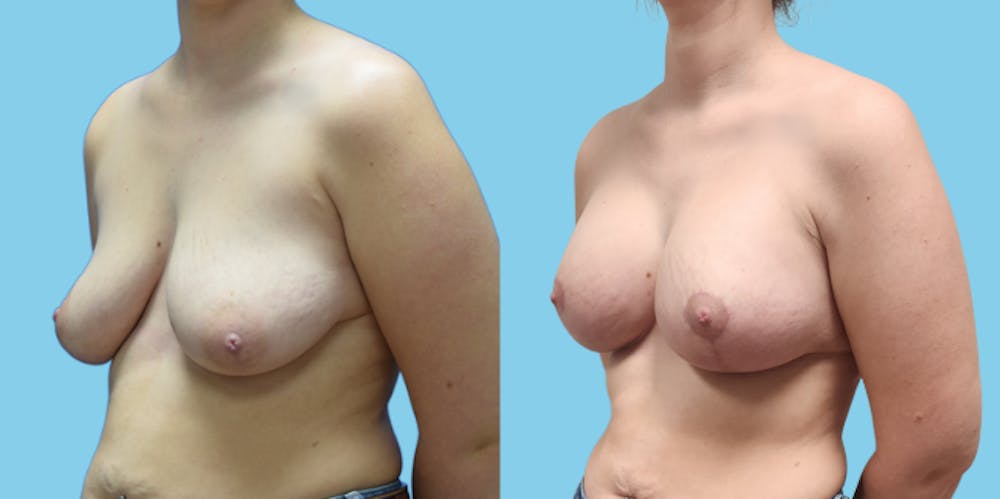 Breast Augmentation Before & After Gallery - Patient 716029 - Image 5
