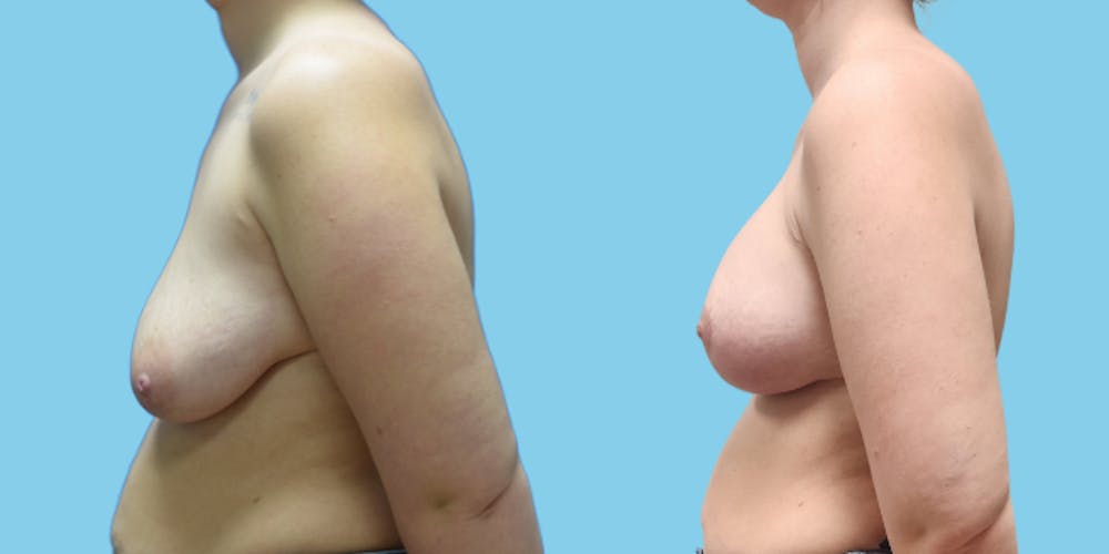 Breast Augmentation Before & After Gallery - Patient 716029 - Image 4