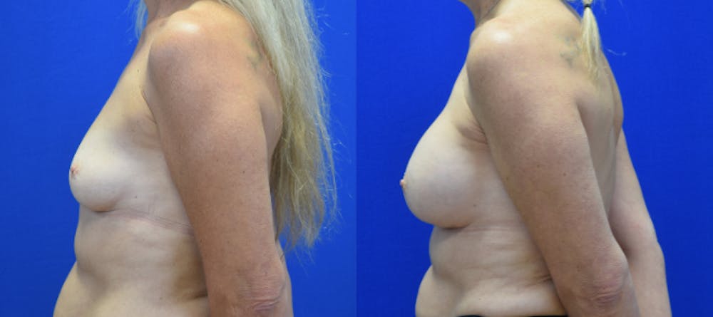 Breast Augmentation Before & After Gallery - Patient 158195 - Image 3