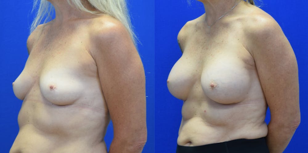 Breast Augmentation Before & After Gallery - Patient 158195 - Image 2