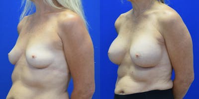 Breast Augmentation Before & After Gallery - Patient 158195 - Image 2