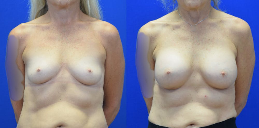 Breast Augmentation Before & After Gallery - Patient 158195 - Image 1