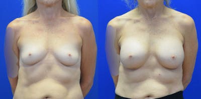 Breast Augmentation Before & After Gallery - Patient 158195 - Image 1
