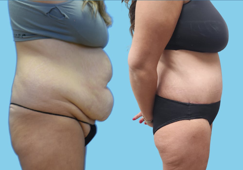 Panniculectomy Before & After Gallery - Patient 962842 - Image 3