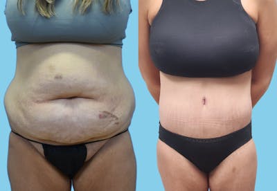 Panniculectomy Before & After Gallery - Patient 962842 - Image 1