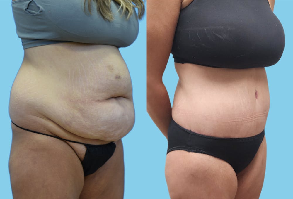 Panniculectomy Before & After Gallery - Patient 962842 - Image 2