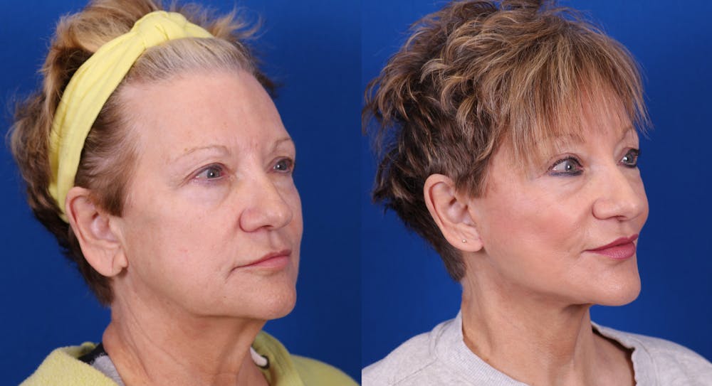 Facelift/Neck Lift Before & After Gallery - Patient 187166 - Image 2