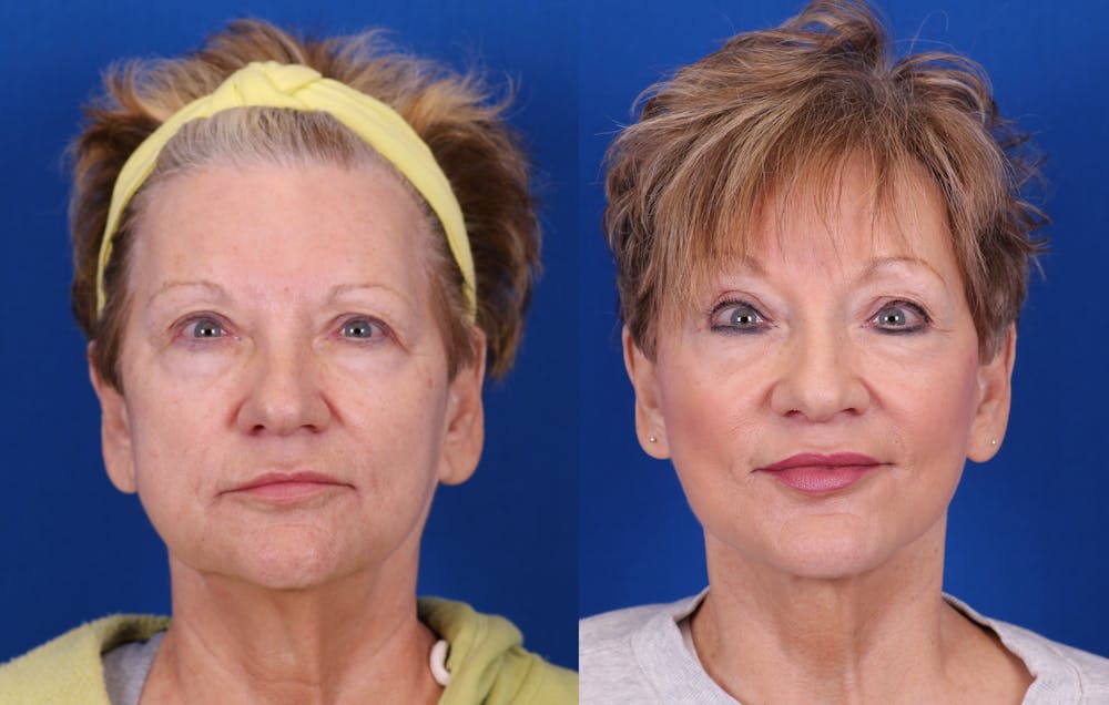 Facelift/Neck Lift Before & After Gallery - Patient 187166 - Image 1