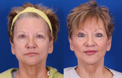 Brow Lift Before & After Gallery - Patient 216845 - Image 1