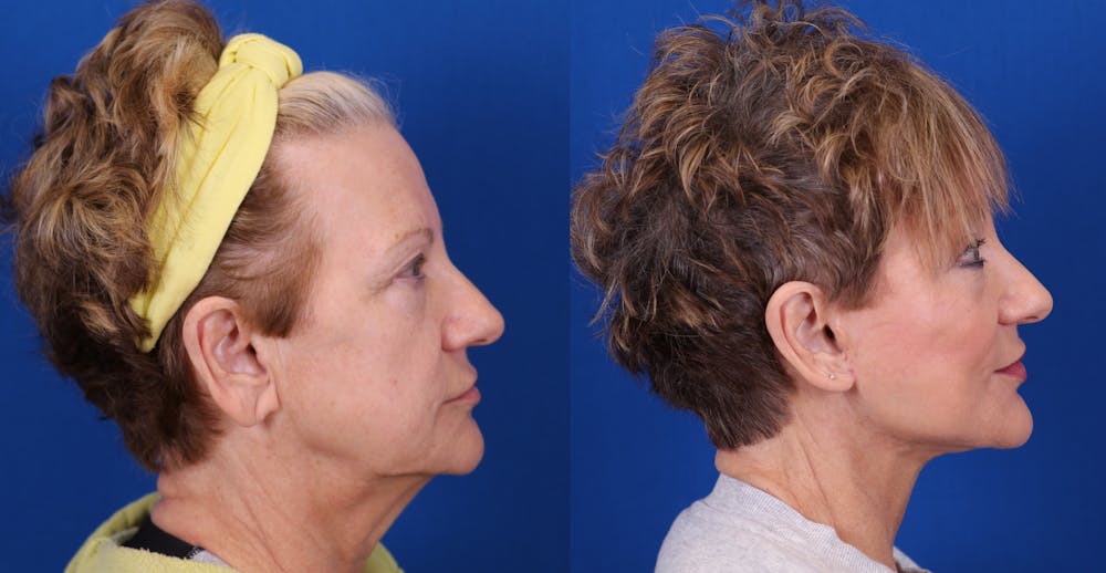 Facelift/Neck Lift Before & After Gallery - Patient 187166 - Image 3