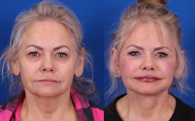 Laser Resurfacing Before & After Gallery - Patient 304157 - Image 1