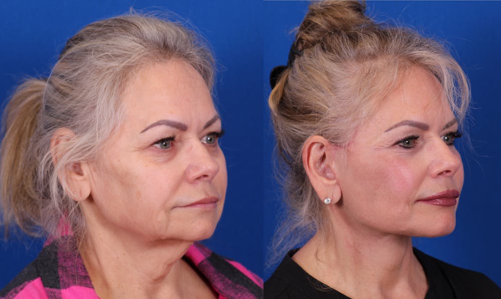 Facelift/Neck Lift Before & After Gallery - Patient 325660 - Image 2