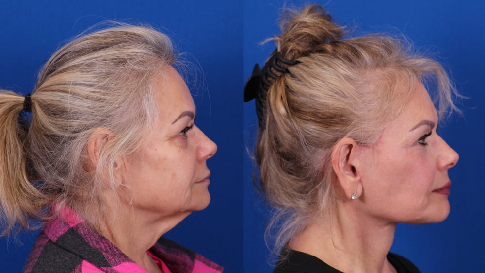 Facelift/Neck Lift Before & After Gallery - Patient 325660 - Image 3