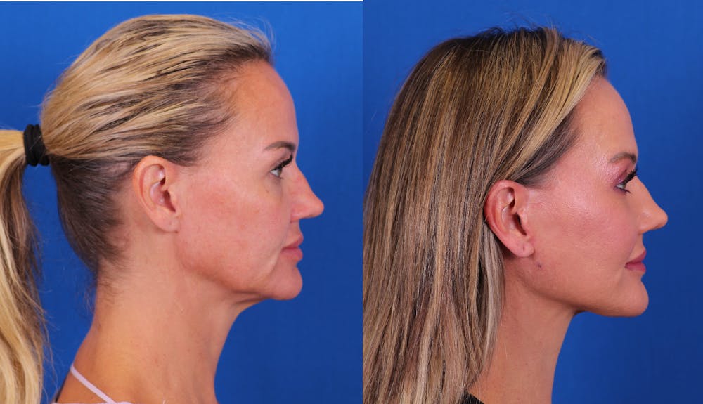 Facelift/Neck Lift Before & After Gallery - Patient 267692 - Image 3