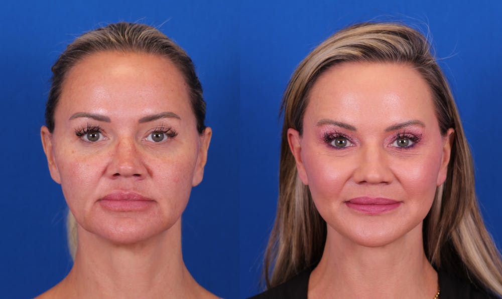 Facelift/Neck Lift Before & After Gallery - Patient 267692 - Image 1