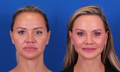 Laser Resurfacing Before & After Gallery - Patient 362637 - Image 1
